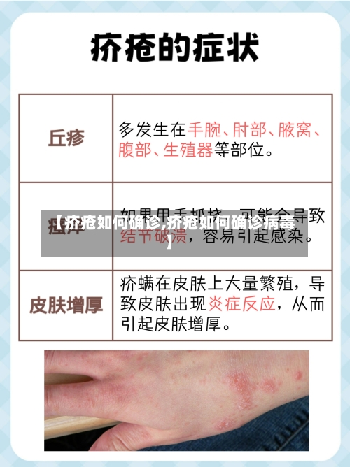【疥疮如何确诊,疥疮如何确诊病毒】