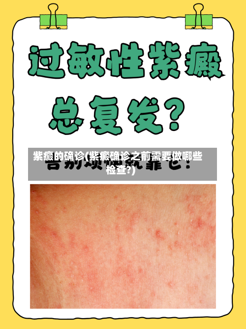 紫癜的确诊(紫癜确诊之前需要做哪些检查?)
