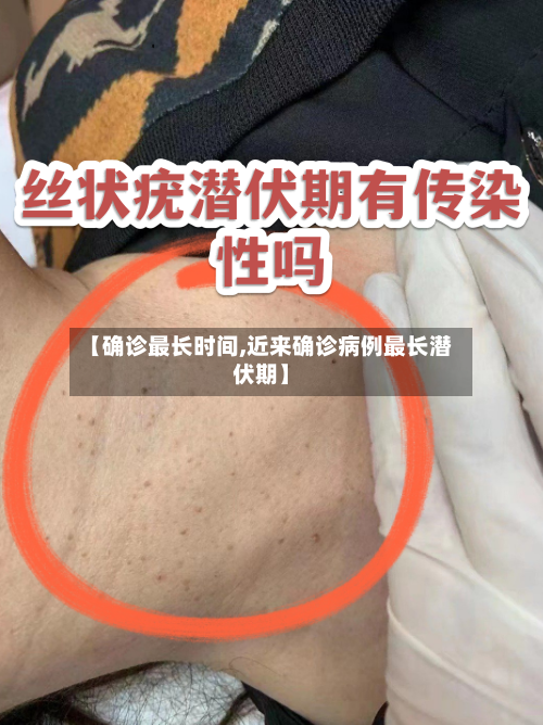 【确诊最长时间,近来确诊病例最长潜伏期】-第2张图片