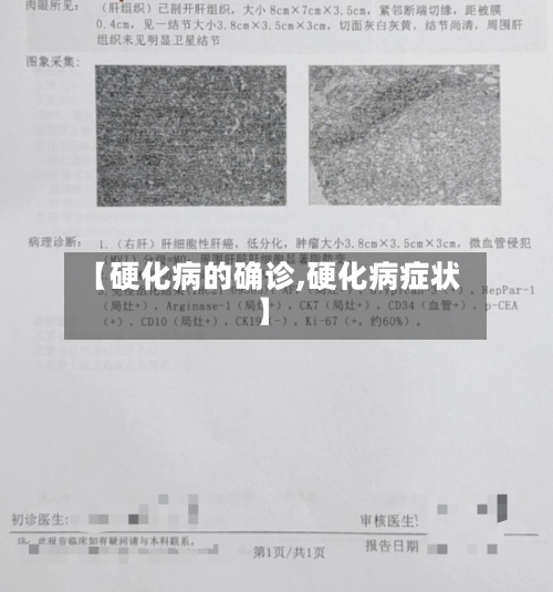 【硬化病的确诊,硬化病症状】