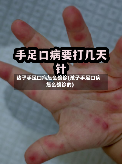 孩子手足口病怎么确诊(孩子手足口病怎么确诊的)-第2张图片