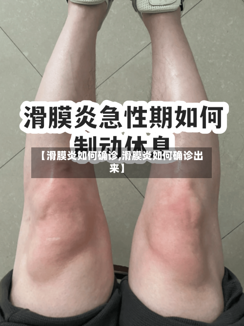 【滑膜炎如何确诊,滑膜炎如何确诊出来】