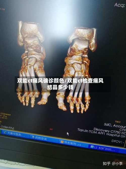双能ct痛风确诊颜色/双能ct检查痛风结晶多少钱