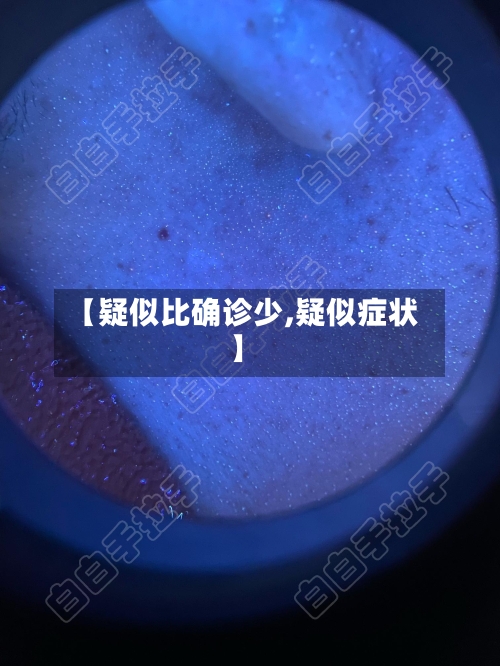 【疑似比确诊少,疑似症状】