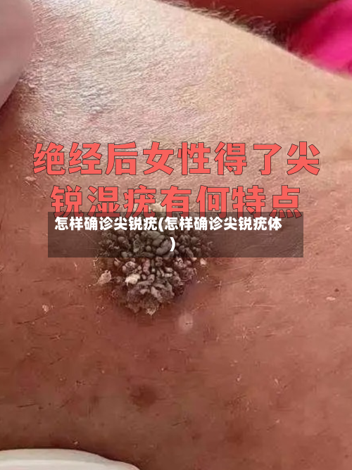 怎样确诊尖锐疣(怎样确诊尖锐疣体)-第3张图片